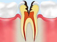 C3（神経の虫歯）