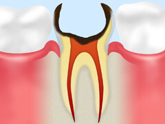 C4（歯根の虫歯）
